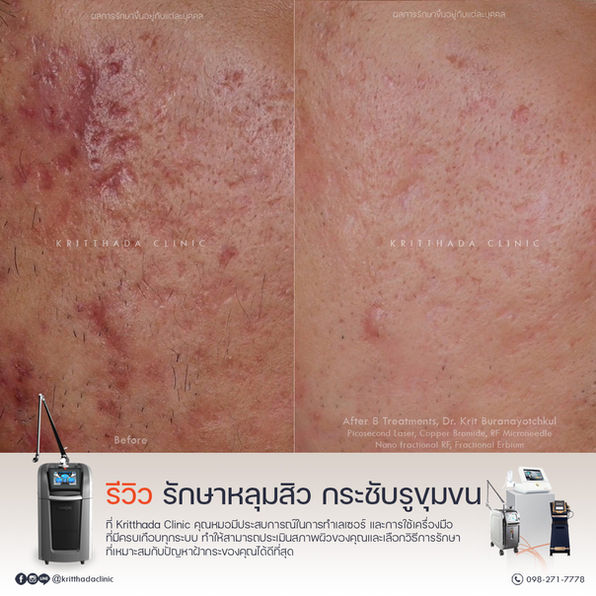 รีวิวเปรียบเทียบก่อนหลังรักษาหลุมสิวด้วยเทคนิค Combination Therapy ผสานหลายเทคโนโลยี ที่ Kritthada Clinic