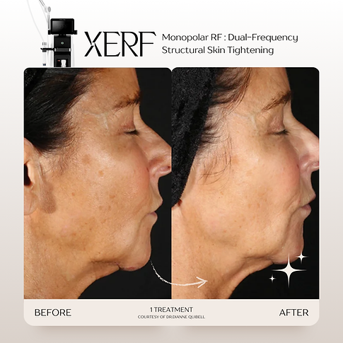 รีวิว XERF ยกกระชับปรับรูปหน้าให้ละมุน 2 คลื่นความถี่ Kritthada Clinic บางนา