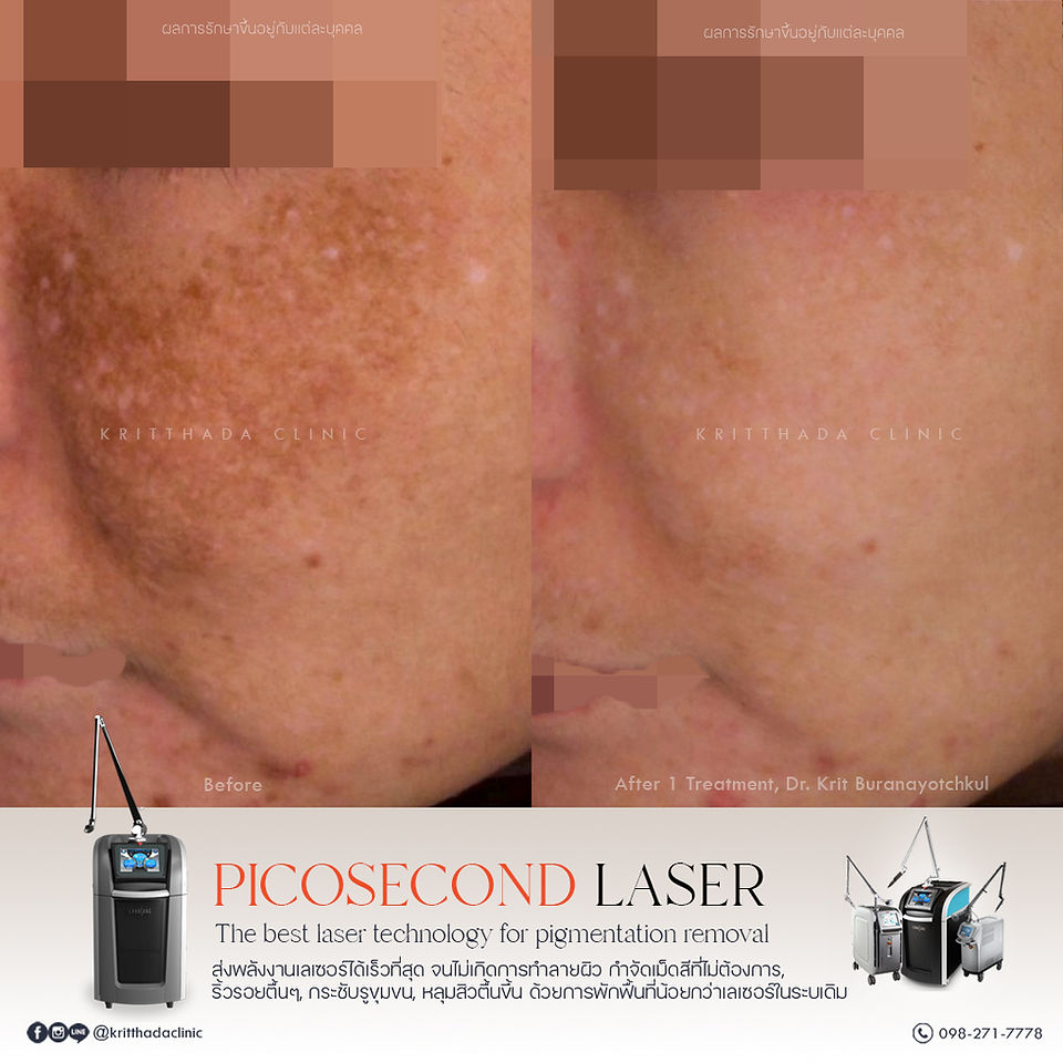 เลเซอร์ picosure pro ฝ้าจางลง รีวิว ก่อนหลัง 1 ครั้ง หน้าตรง กริตธาดาคลินิก