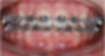 recuo mandibular