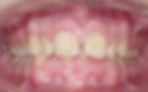 recuo mandibular
