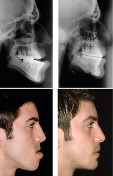 prognatismo mandibular