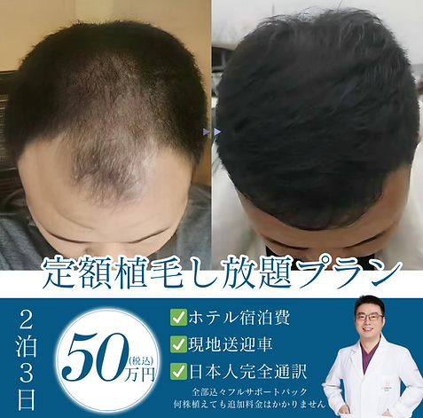 定額植毛し放題プラン