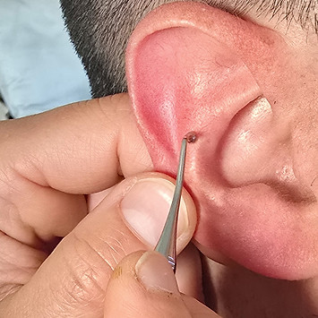 Auriculotherapie zur Unterstützung von Entspannung und Balance
Ohrakupressur in der Naturheilpraxis Horgen