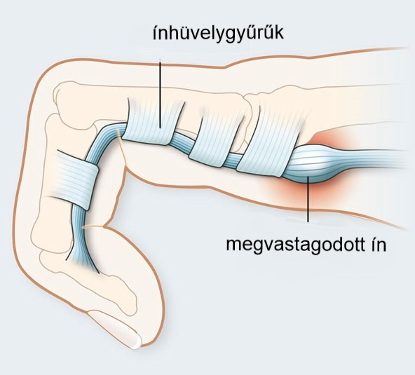 Ínhüvelygyulladás 4 oka, 4 tünete, 5 kezelési módja [teljes útmutató]