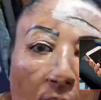 Joven sufre graves quemaduras tras explosión de su celular mientras dormía: alerta por práctica común