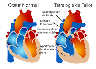 Tetralogy_of_Fallot.png