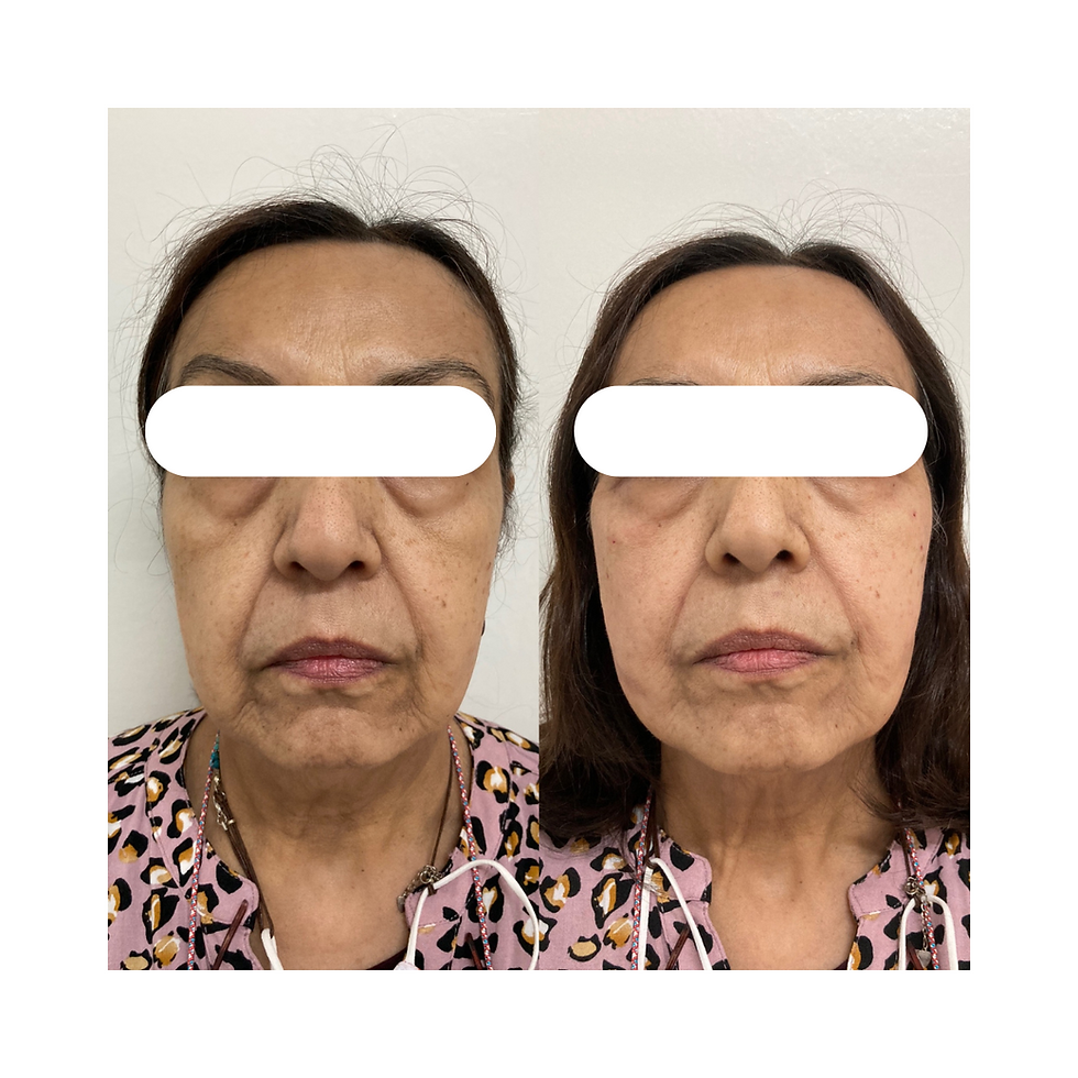 28Noeva-Clinic-Rejuvenecimiento Facial