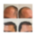 9Noeva-Clinic-Implante Capilar.png