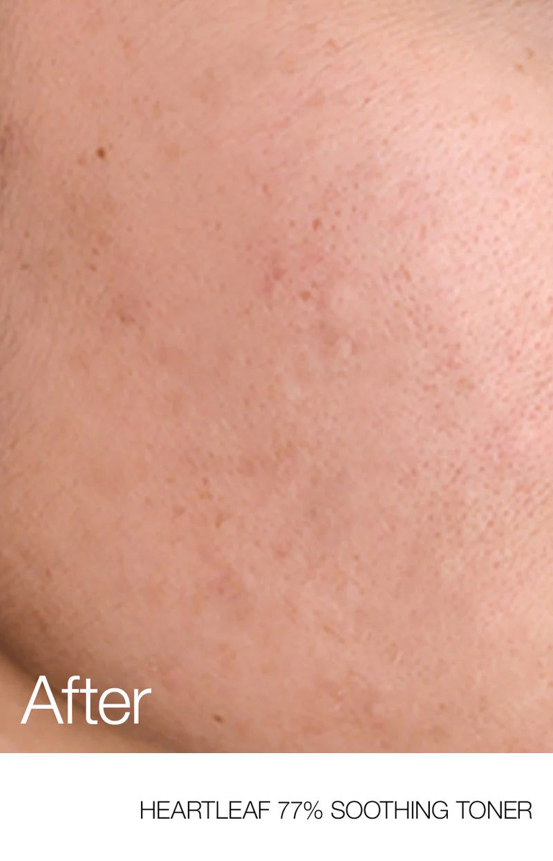 Thumbnail: Anua Heartleaf 77% Soothing Toner