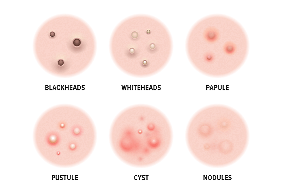 You might have a variety of breakouts, including blackheads and whiteheads, as well as other problems like clogged pores, sebaceous filaments, papules, and pustules.