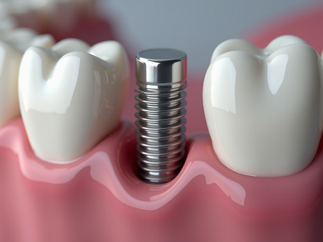 Everything You Need to Know About Dental Implants for a Perfect Smile