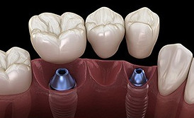 implants-5.jpg