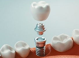 implants-4.jpg