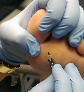 Callus Debridement.jpg