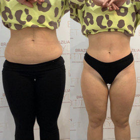 Body Contouring Swanley