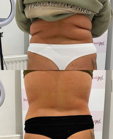 Body Contouring in Swanley