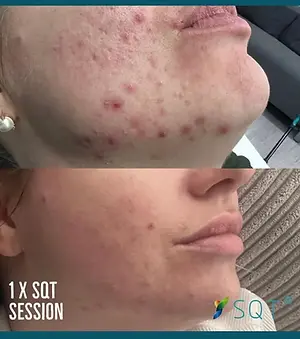 Bio-Microneedling Resurfacing, Skin Diva Studio, Bowmanville spa