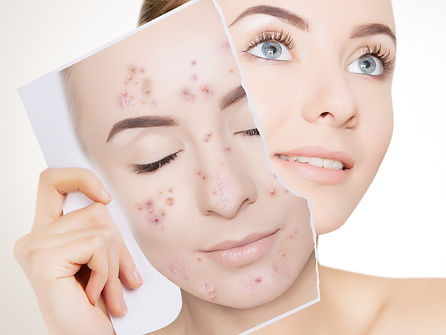 Medicated Acne Buster 