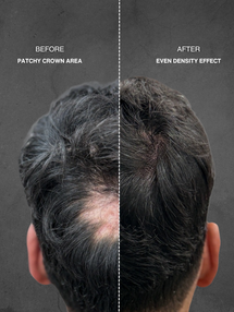 Scalp micropigmentation before and after results for thinning crown hair.