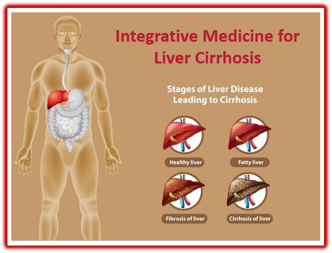 Integrative Medicine for Liver Cirrhosis