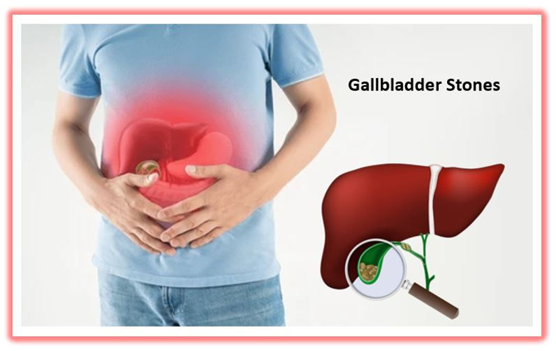 Integrative Medicine for Gallbladder Stones