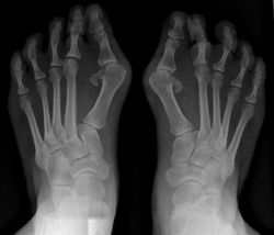 Severe_hallux_valgus_deformity1
