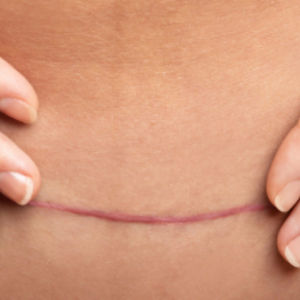 A Hypertrophic Scar after c-section which looks like a red bootlace