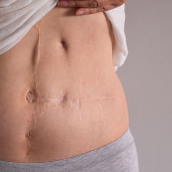 Hysterectomy Scar.jpg