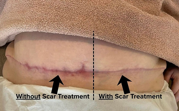 A photo showing a large scar on a stomach after a tummy tuck. the photo has a line down the middle, one side the scarring is very red and indicates that no scar treatment has been given  on that half of the scar, compared to the other half with treatment which shows a much smoother, neat scar which is much lighter in appearence.
