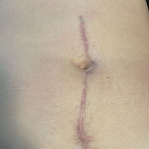 A keloid scar runningabove and below a belly button