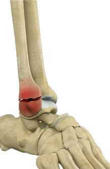 zlomenina-fracture.png