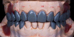 Diagnostic Wax Up with proposed gingival recontouring/crown lengthening