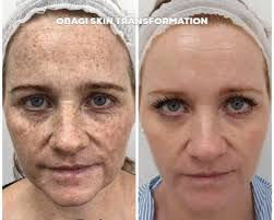 Thumbnail:  Obagi Nu-Derm Skin Transformation System Normal to Dry