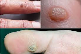 warts.jpeg