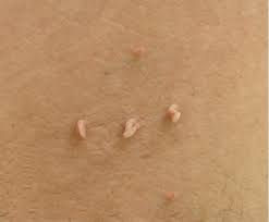skin tag.jpeg