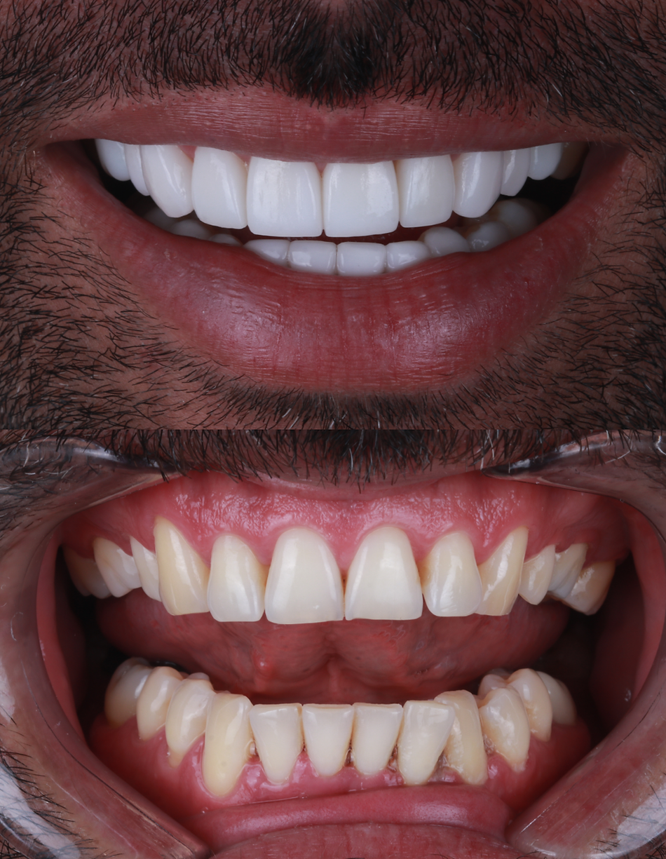 cosmetic dental mexico