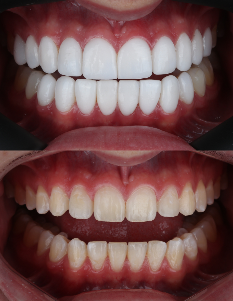 veneers before and after