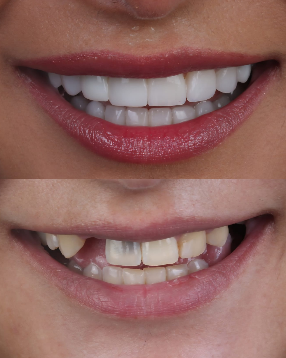 teeth veneers before and after