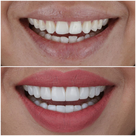 Discover the Hidden Benefits of Dental Tourism in Colombia: Why More Patients Are Choosing Colombia for Smile Makeovers