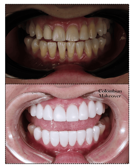 compositve veneers colombia