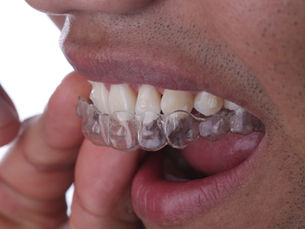 Invisible Orthodontics in tijuana Mexico
