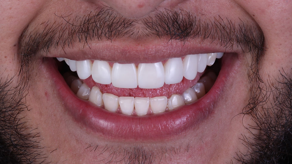FAQ: Composite Veneers in Mexico