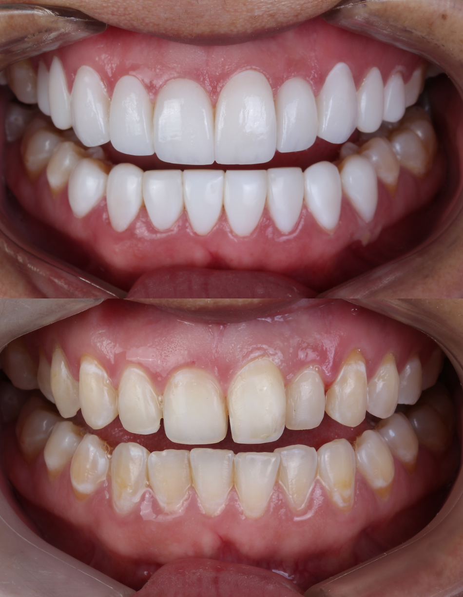 porcelain and composite veneers