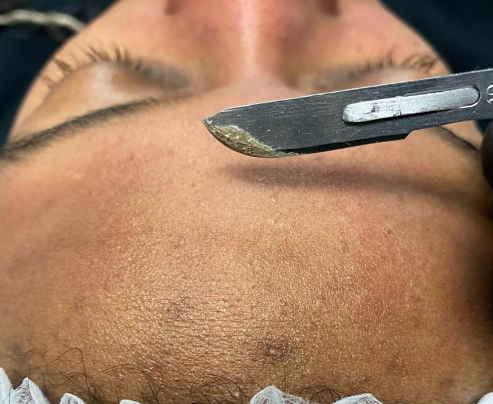 Dermaplaning