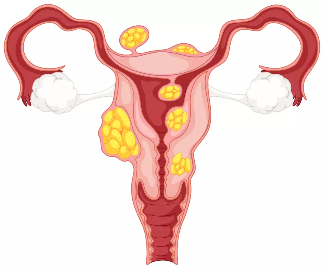 les aliments à éviter en cas de fibromes