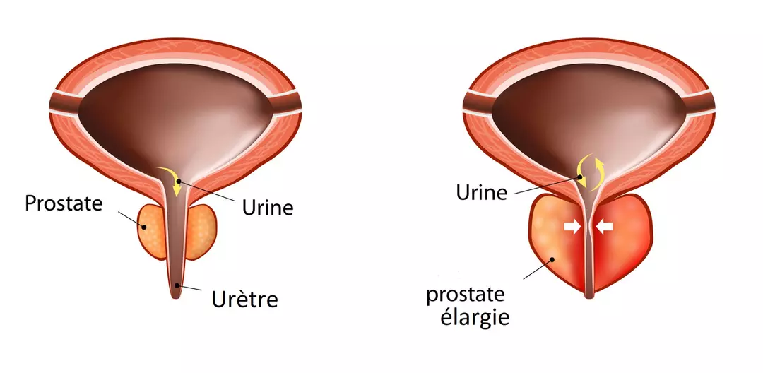 inflammation de la prostate