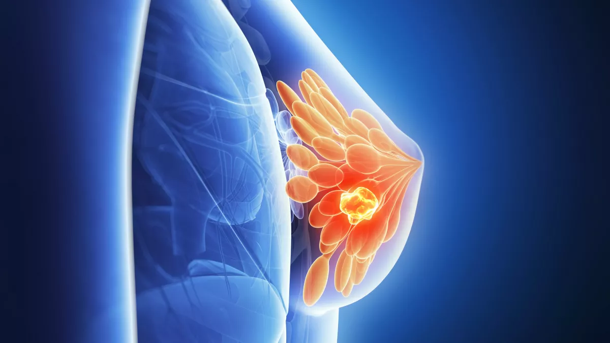 plantes pour soigner le cancer du sein