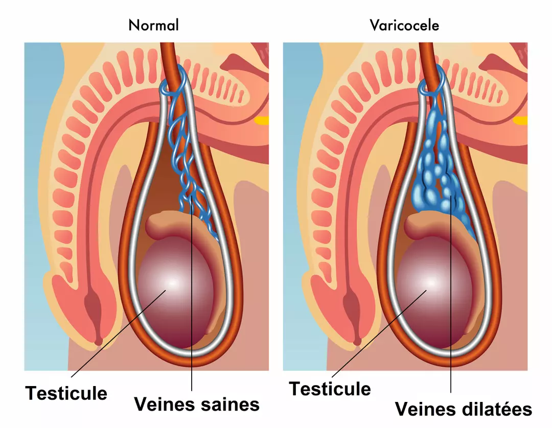 varicocèle