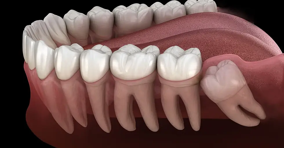 20lik diş çekimi mavident.webp